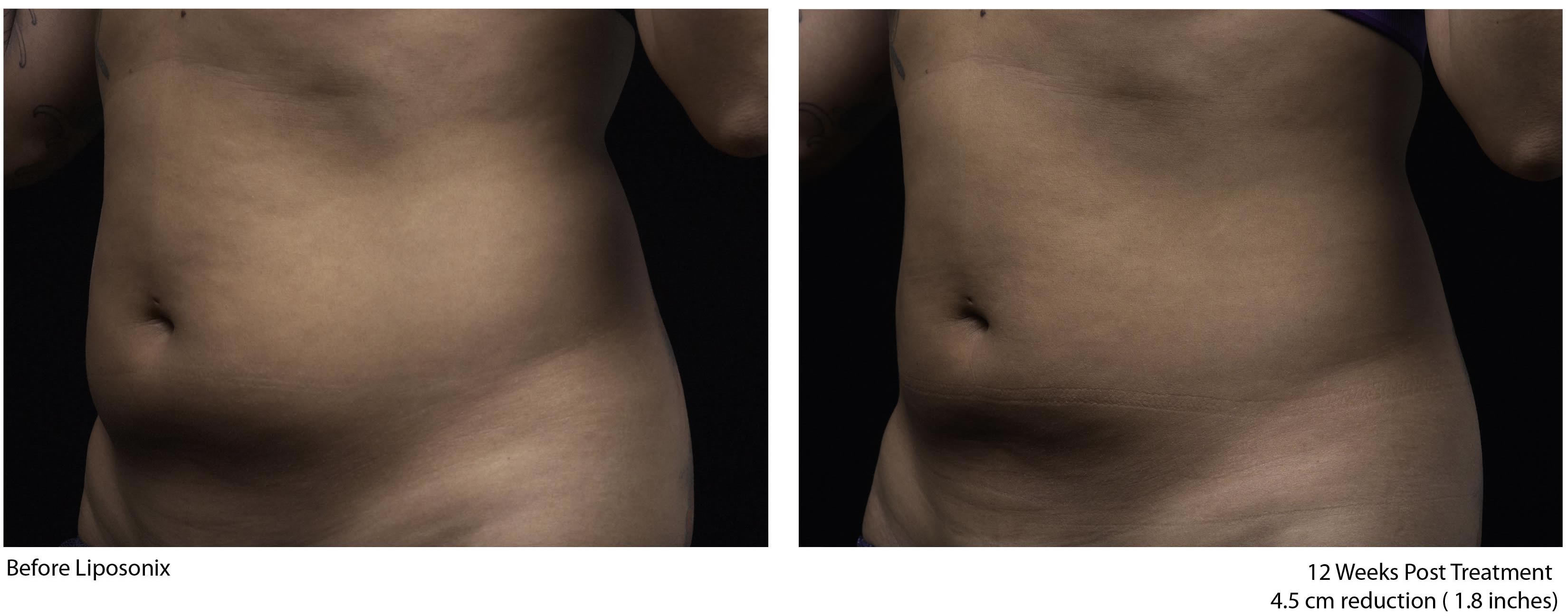 Liposonix NYC Before and After Photos.